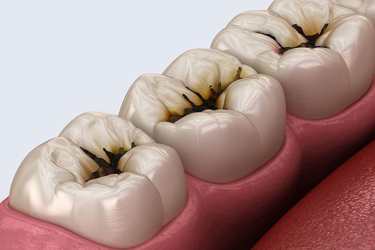 лечение кариеса в стоматологии Denta Art